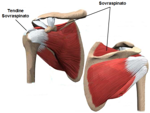 sovraspinato